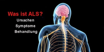 Was ist ALS? Ursachen, Symptome, Behandlung und Empfehlungen