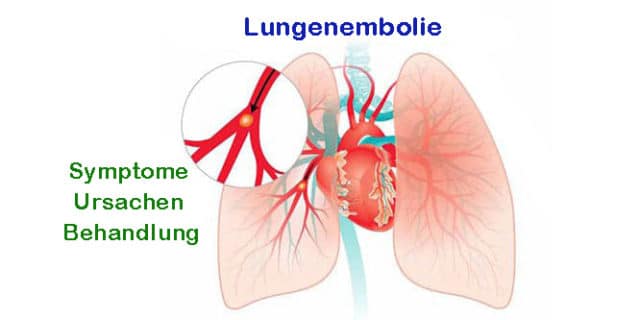 Wie Lange Kann Man Unbemerkt Eine Lungenembolie Haben gesundheitundheilung.de
