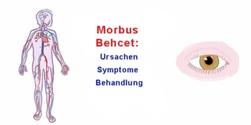 Morbus Behcet: Ursachen, Symptome, Behandlung