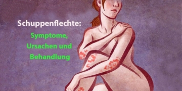 Schuppenflechte (Psoriasis): Symptome, Ursachen und Behandlung